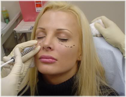 sculptra injection