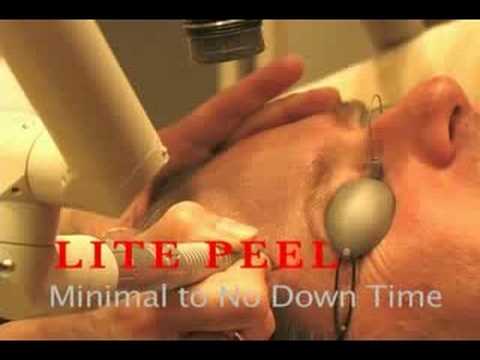 Erbium Laser Resurfacing