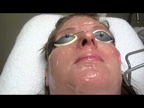 Rosacea Treatment With Laser-Anaheim-Brea-Fullerton-Yorba Linda-Chino Hills-Corona