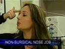 Non Surgical Nose Job With Radiesse