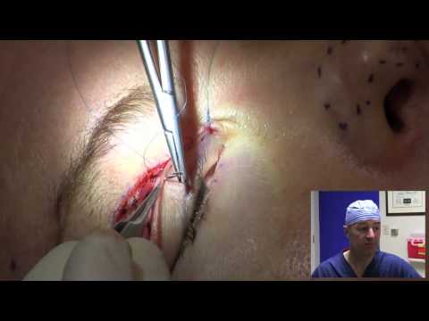 Eyelid Surgery in 10 Minutes