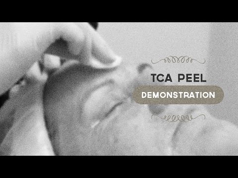 35% TCA peel demonstration