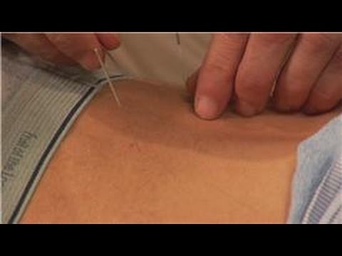 Acupuncture Treatments : Acupuncture as Treatment for Back Pain
