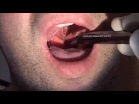 LAUP: Laser assisted uvulopalatoplasty