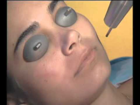 Non Ablative Laser Skin Rejuvenation Information