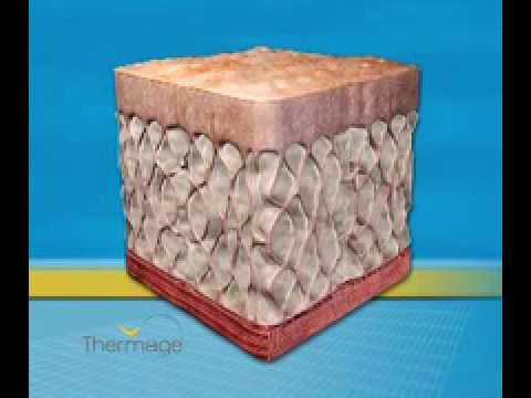 Thermage Explained : Dr Gerrish
