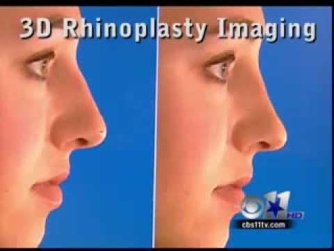 Rhinoplasty - 3D Computer Imaging | Nose Job Before &amp; After Photos - Dr Spencer Cochran - Dallas