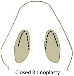 closed rhinoplasty