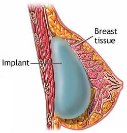subglandular breast implant