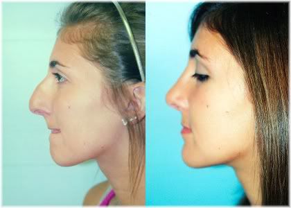 rhinoplasty female before and after