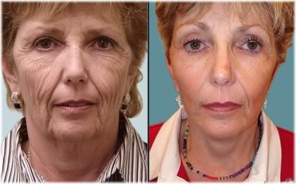 facelift after weight loss