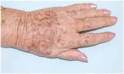 age spots on hands