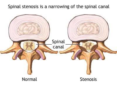 spinal stenosis