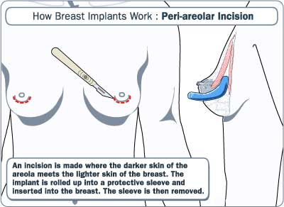 Periareolar Incision
