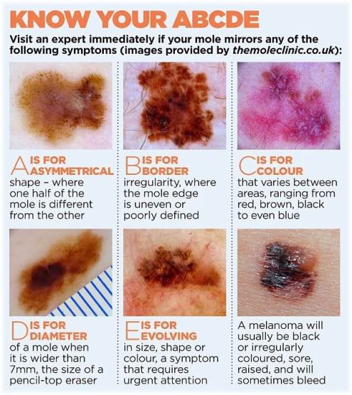 moles and skin cancer