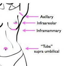 breast augmentation incision locations
