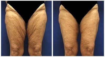 Before and after inner thigh lift.