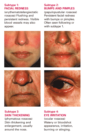 stages of rosacea