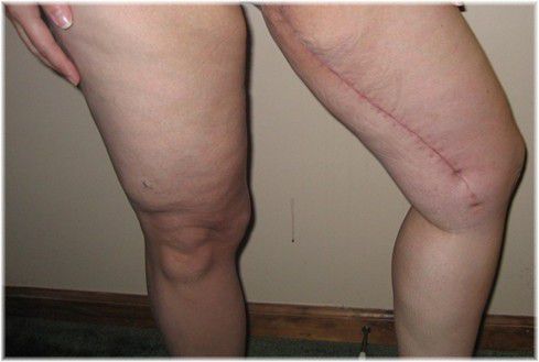 thigh lift scar