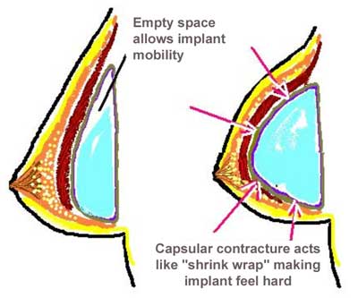 capsular contraction