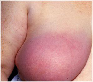 swollen breast