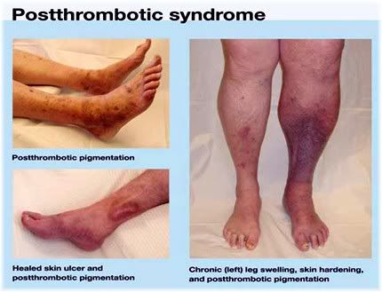 postthrombotic syndrome