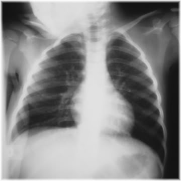 chest x-ray