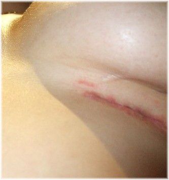 breast scar