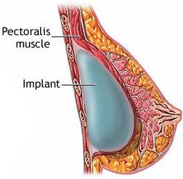 submuscular breast implant