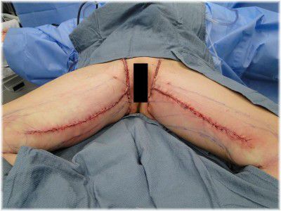 vertical thighplasty