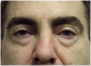 lower eyelid sagging