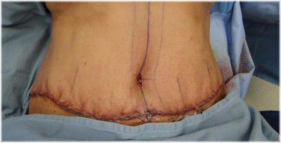 extended abdominoplasty