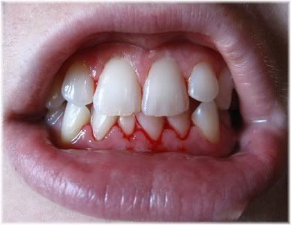 bleeding gums