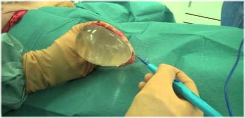 surgeon with breast implant