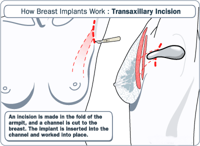 Transaxillary Incision