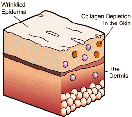 collagen depletion