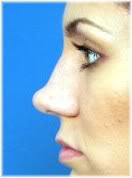 Nasal Tip Projection