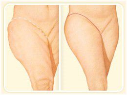 lateral thigh lift
