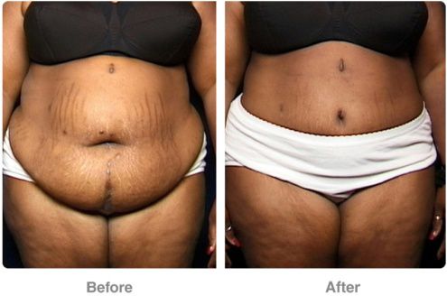 before and after tummy tuck