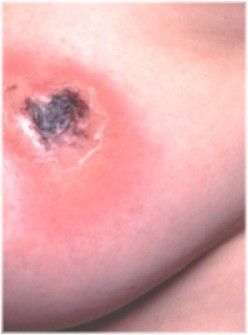 breast abscess