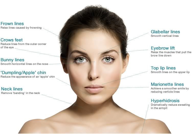 Botox application sites