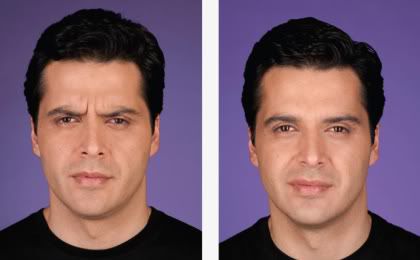 Botox before after 2