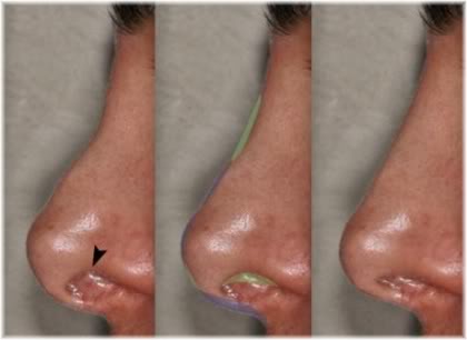 revision rhinoplasty