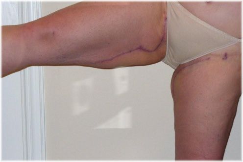 thigh lift scar