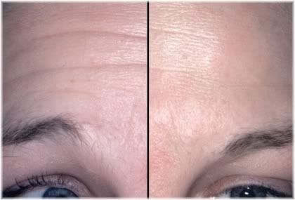 Botox forehead before after