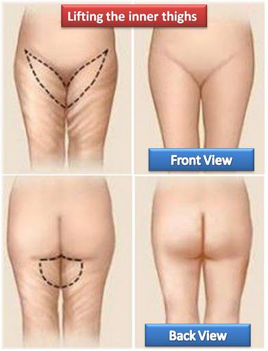 inner thigh lift