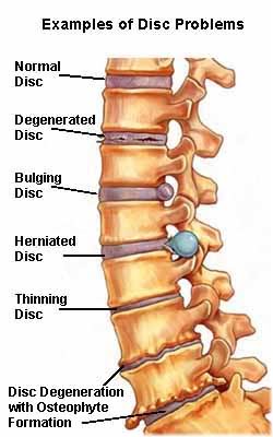 spinal disc problems