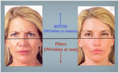 Botox and dermal filler on the face