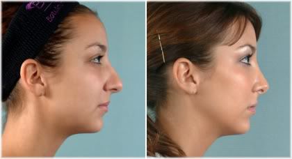 before after female nose job