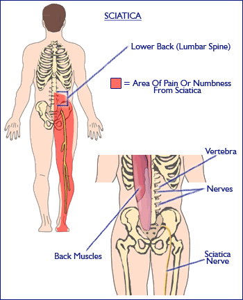 sciatica